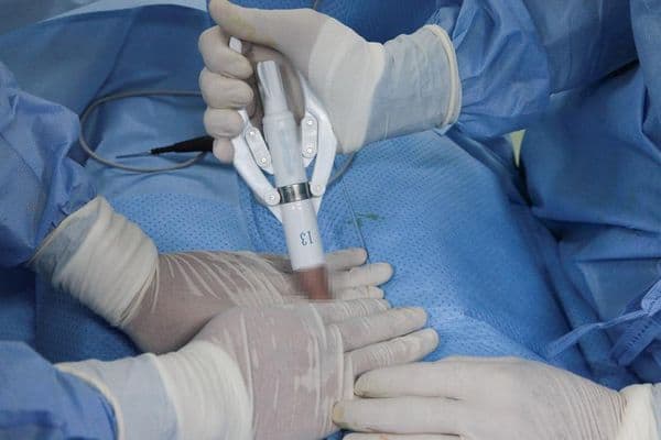 Bệnh viện Đa Khoa Thanh Vũ Medic tại Bạc Liêu đã và đang áp dụng kỹ thuật cắt da quy đầu bằng máy với công nghệ STAPLER