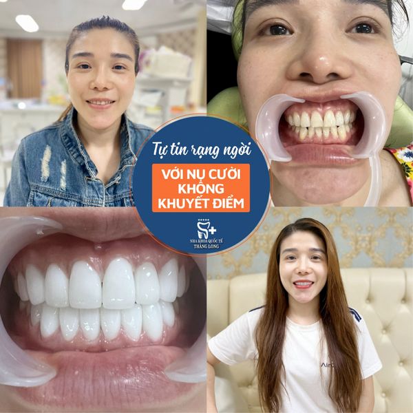 ự kết hợp giữa chất lượng vượt trội và mức giá vô cùng phải chăng chính là điểm độc đáo của Nha Khoa Quốc Tế Thăng Long.